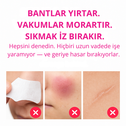 SoftDerm™ Mikro Darbeli Gözenek Temizleme Cihazı