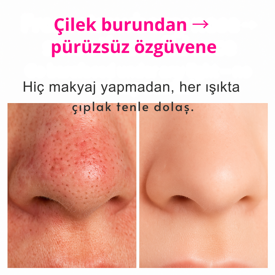 SoftDerm™ Mikro Darbeli Gözenek Temizleme Cihazı